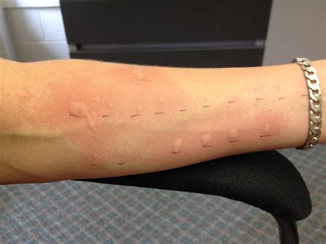 scratch test hives|allergic reaction skin hives.